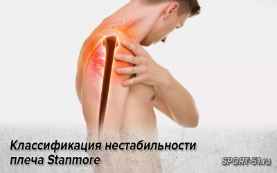 Классификация нестабильности плеча Stanmore