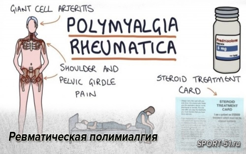 Ревматическая полимиалгия