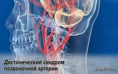 Дистонический синдром позвоночной артерии