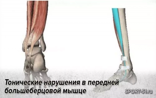 Тонические нарушения в передней большеберцовой мышце